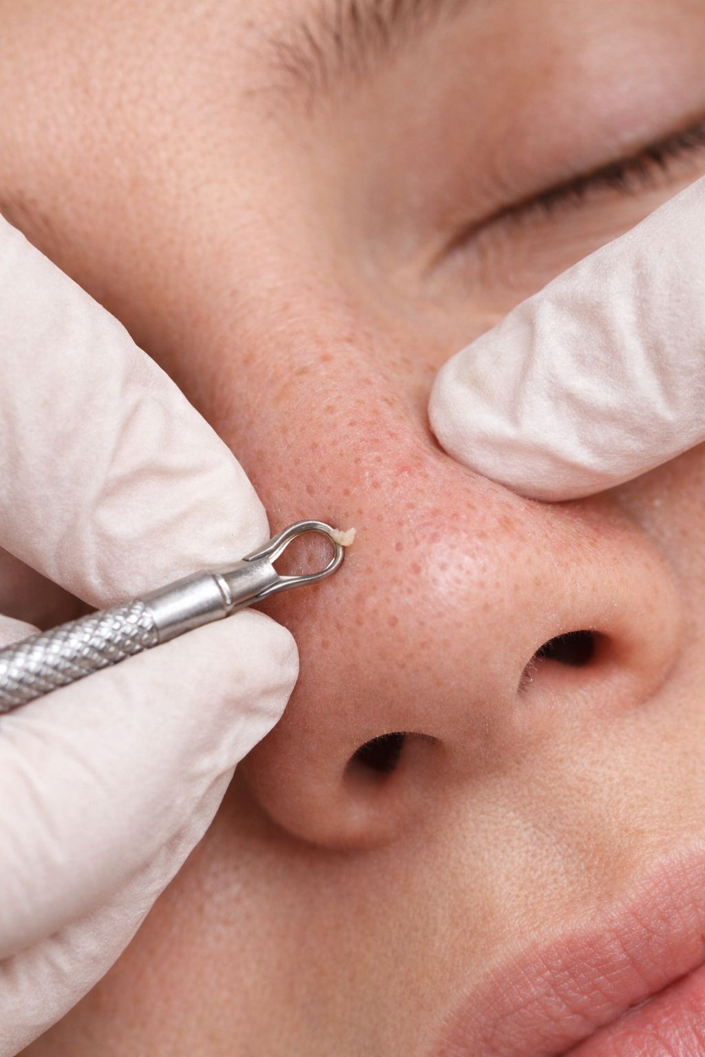 Akne ve Yağlı Cilt Bakımı